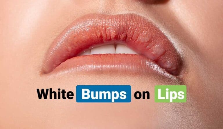 factors-that-cause-tiny-white-bumps-on-lips-healthy-active