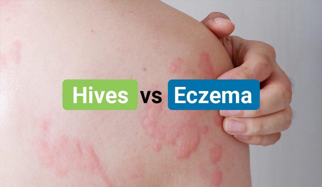 hives-vs-eczema-differences-similarities-causes-treatments