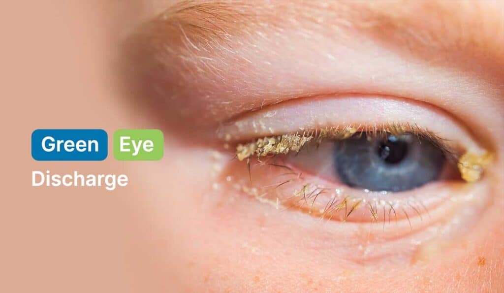 Does Green Eye Discharge Mean Infection